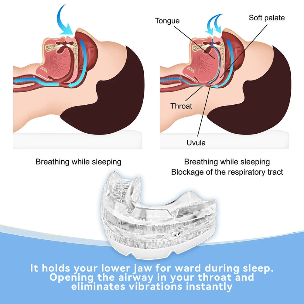 Anti Snoring Mouth Guard